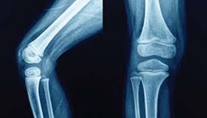 Osteotomia, cos'è e perchè a volte è necessaria