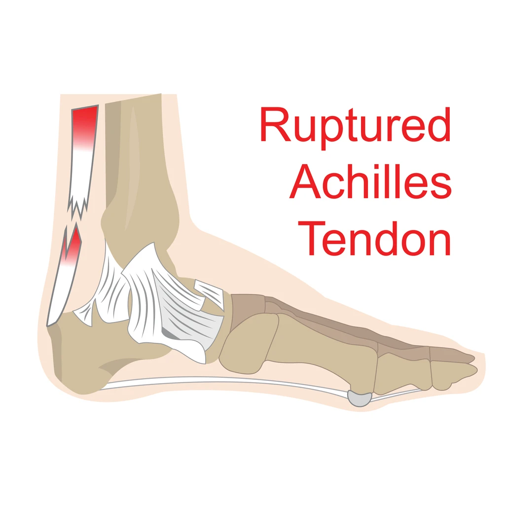 Rottura del tendine di Achille : sintomi, cure e riabilitazione