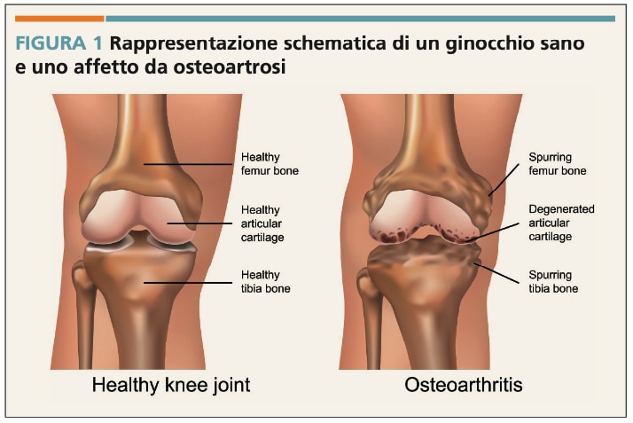 Le cause più frequenti dell'osteoartrosi