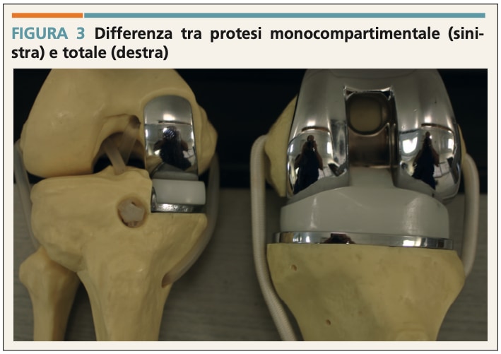 protesi ginocchio
