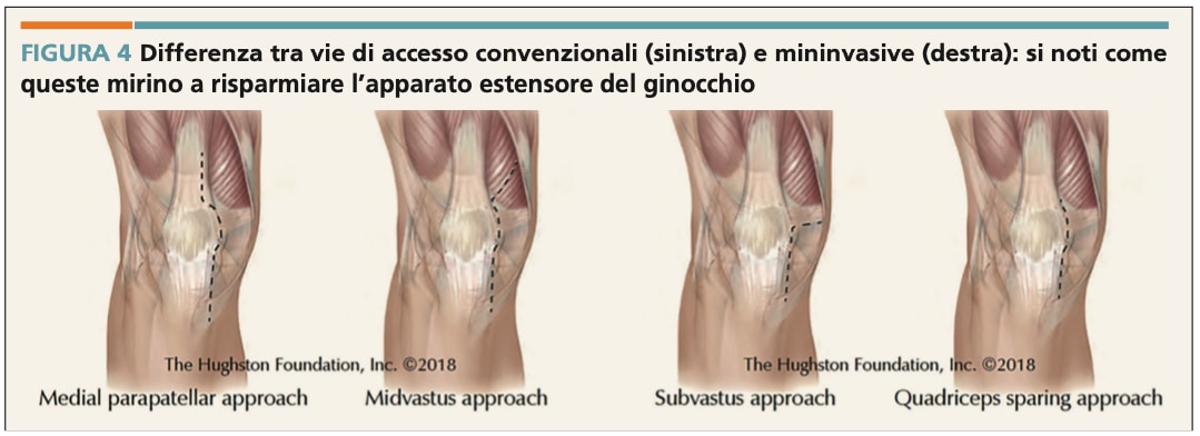 operazione ginocchio