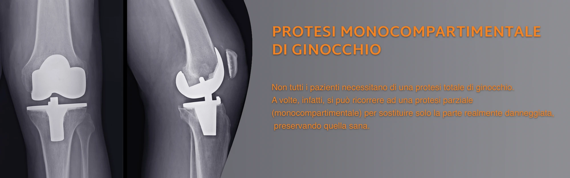 protesi ginocchio monocompartimentale